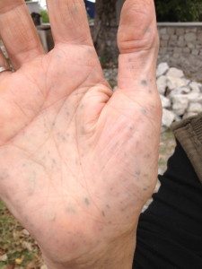 Woman with extensive hand shrapnel from war